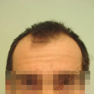 hajátültés (hajbeültetés) előtt