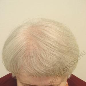 hajátültetés, hajbeültetés női diffúz hajhiány esetén. Műtét után