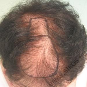 hajátültetés, hajbeültetés női diffúz hajhiány esetén. Műtét előtt