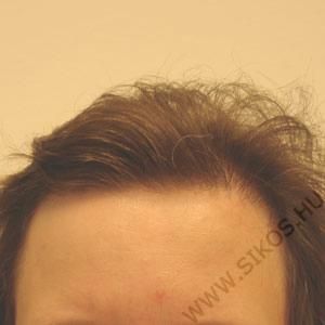 hajbeültetés, hajátültetés női paciens hajvonal pótlása után