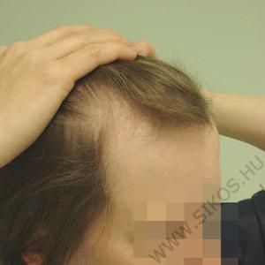 hajbeültetés, hajátültetés női paciens hajvonal pótlása előtt