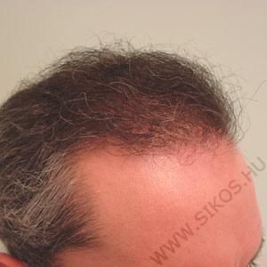 Hajátültetés (hajbeültetés) után