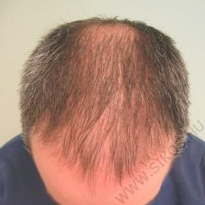 Hajátültetés (hajbeültetés) előtt