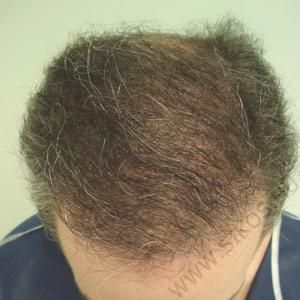 Hajátültetés (hajbeültetés) után