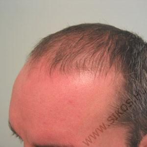 Hajátültetés (hajbeültetés) előtt