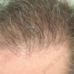 Hajátültetés (hajbeültetés) után elülső hajzóna közelről
