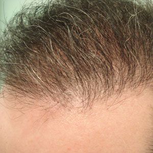 Hajátültetés (hajbeültetés) után elülső hajzóna közelről