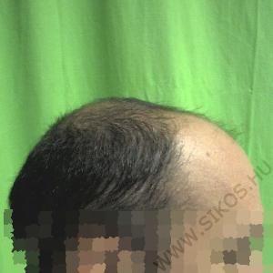 Hajátültetés (hajbeültetés) előtt